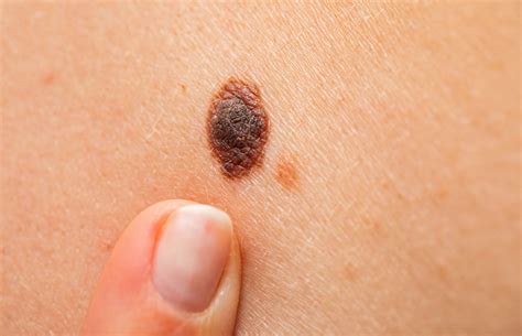 what does a cancerous mole look like | Symptoms and pictures