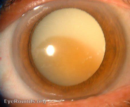 Morgagnian cataract. EyeRounds.org: Online Ophthalmic Atlas