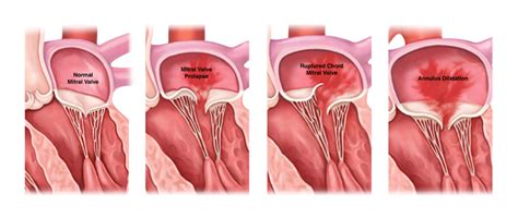 Mitral Regurgitation: A “Leaky Valve” - Gregory Koshkarian, MD, FACC