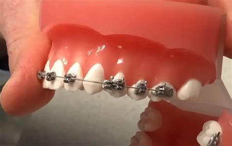 Broken Bracket On Braces? The 3 Things You NEED To Do