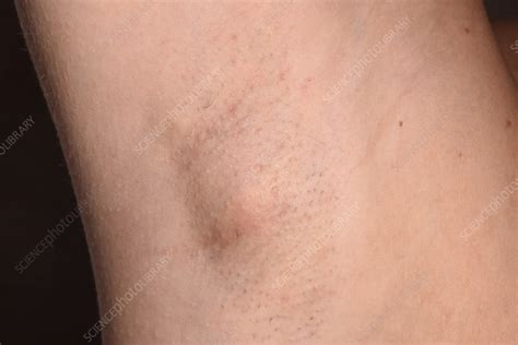 Swollen Lymph Nodes In Armpit: Symptoms, Causes, And, 53% OFF