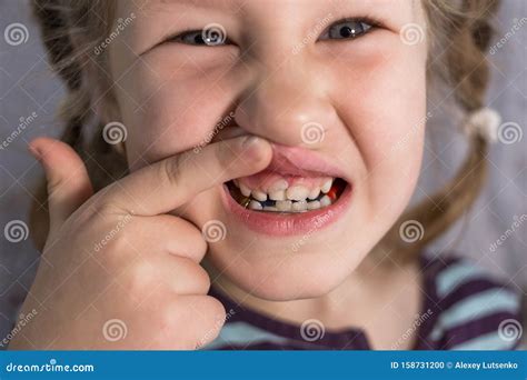 Adult Permanent Teeth Coming in Front of the Child`s Baby Teeth: Shark Teeth Stock Photo - Image ...