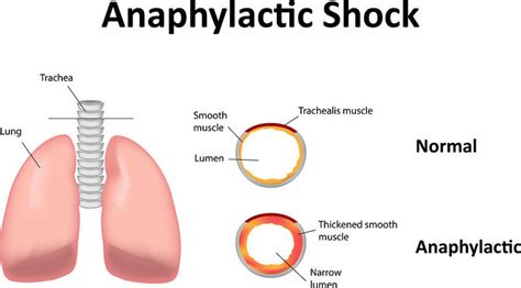 13 Anaphylactic Shock Symptoms and Things That Cause Them