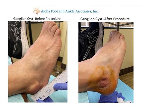 What is a ganglion cyst?: Aloha Foot and Ankle Associates: Podiatry