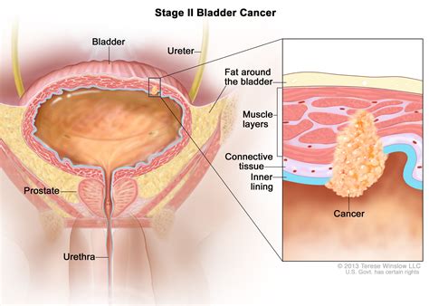 Bladder Cancer Treatment (PDQ®) - NCI