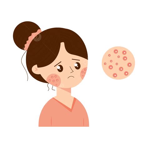 Vector Illustration Of Woman With Acne Skin Type, Acne, Acne Face, Skin ...