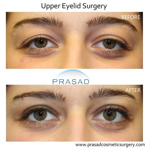 What Causes Heavy Lidded Eyes and How to Treat Them