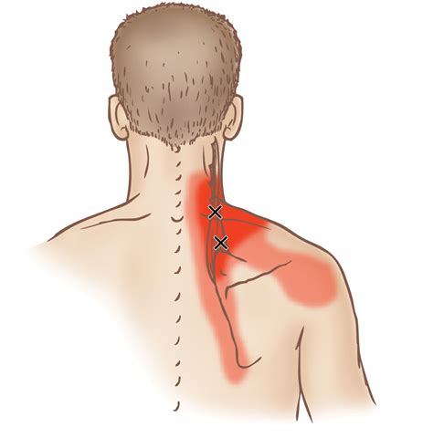 Levator Scapulae Trigger Points Frankenstein Pain