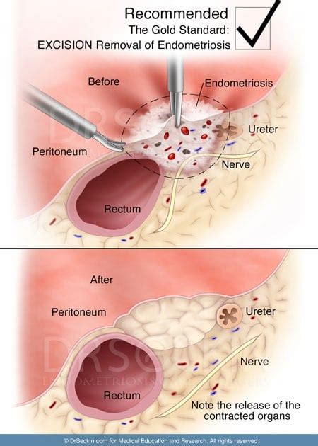 Endometriosis Surgery - Endometriosis Excision Surgery | Seckin