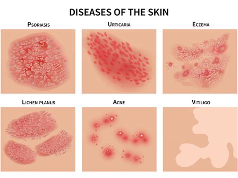 Inflammatory Skin Disorders - Nutritional Therapist, Tavistock, Devon ...