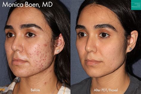 Scar & Acne Scar Treatment | San Diego, CA | CLDerm