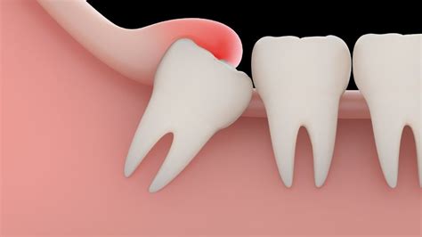 The Ultimate Guide to Wisdom Teeth Recovery - Burwood Dental Care