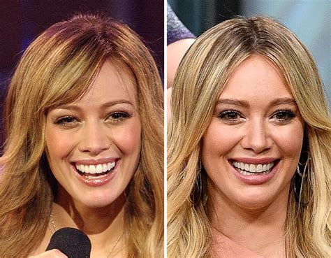 Celebs who have veneers that look good and celebs who have veneers that ...