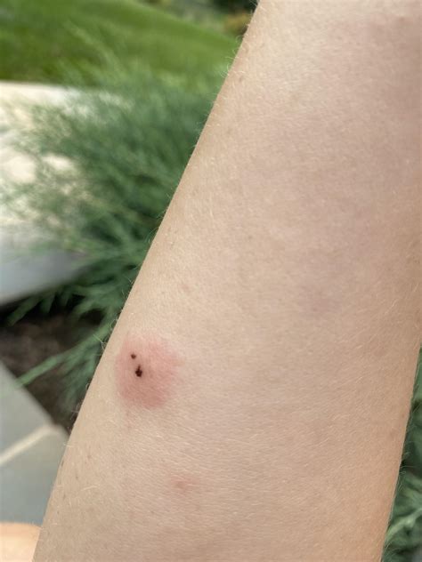 Is this a brown recluse bite? 3 days in, after cleaning off some gunk ...