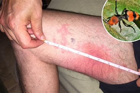 Florida Man in Excruciating Pain After Being Stung by 'Cow Killer' Ant ...