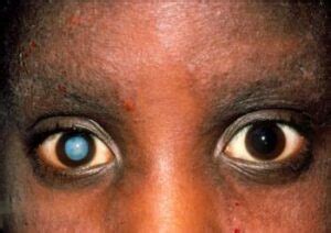 Mature Cataract: Signs, Causes, Effects, Diagnosis, Treatment