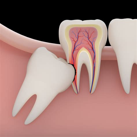 Do Wisdom Teeth Always Come In - TeethWalls