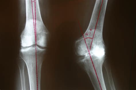 Valgus Knee Arthritis - Dr. Stuart Kozinn, MD - TotalKnee.Org Dr. Stuart Kozinn, MD – TotalKnee.Org