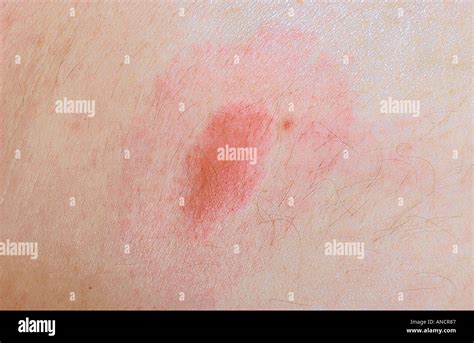 Target Rash from Deer Tick Bite Transmitting Lyme s Disease Stock Photo - Alamy