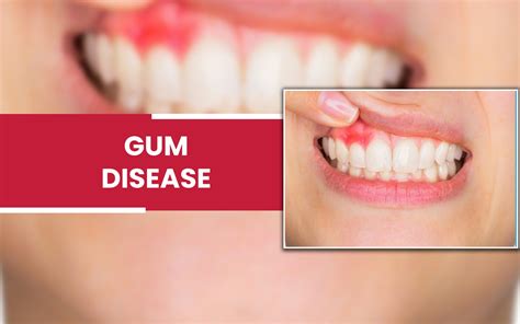 Gum Disease Treatment | Wilmot Family Dentistry