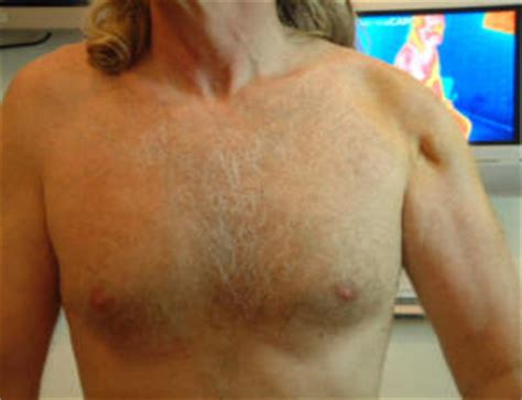 Atrophy of shoulder muscle - Arthritis USA - The Center for ...