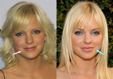 Anna Faris Plastic Surgery REVEALED (Before & After 2021)