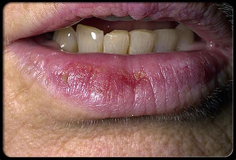 Skin Cancer Lower Lip Photos - Infoupdate.org