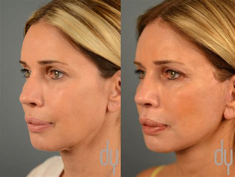 Facelift Before and After | Deep Plane Facelift Recovery