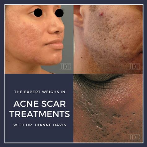 Acne Scar Treatments: The Expert Weighs In - Next Steps in Dermatology