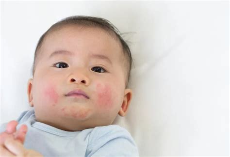 Baby Teething Rash: Causes, Home Remedies & Prevention