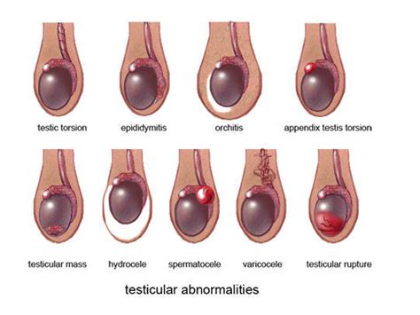 Testicular Cancer Signs - Ultrasound Scan Dublin - Ultrasound Dimensions 012100232