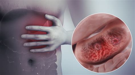 Various reasons for Stomach Ulcer - Scientific Animations