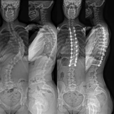 Scoliosis Surgery | South Australian Scoliosis Service