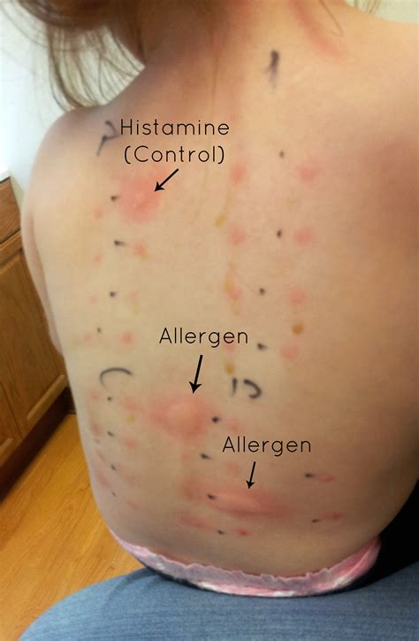 Allergy Skin Test Results Chart