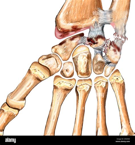 Ulnar Ligament Wrist