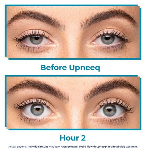 How Upneeq Eye Drops Provide an Instant Eye-Lift Effect