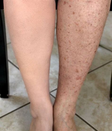 Waterproof Leg Makeup For Spider Veins | Saubhaya Makeup