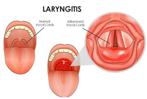 Laryngitis : Causes, Picture, Symptoms And Treatment