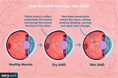 How Dry AMD Becomes Wet AMD