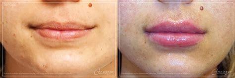 Juvederm Voluma In Lips | Lipstutorial.org