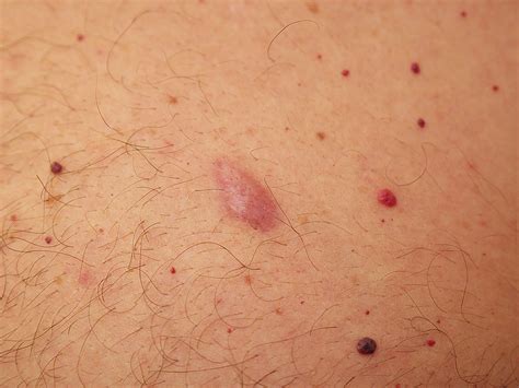 Common lumps and bumps on and under the skin: what are they? - Dermatology Research Centre ...