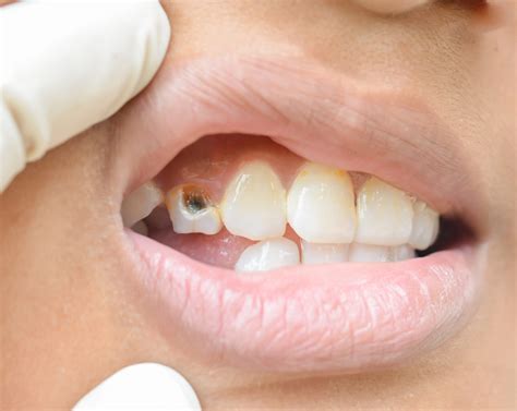 What To Do When Front Tooth Cracked | Springvale Dental Clinic