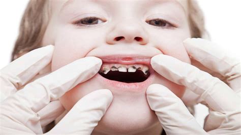 Kid’s multiple dental cavities treatment (full mouth rehabilitation)