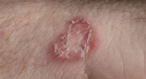 Dos and don'ts to treat fungal skin infections | TheHealthSite.com