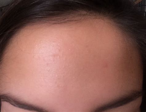 Small Red Bumps On Forehead