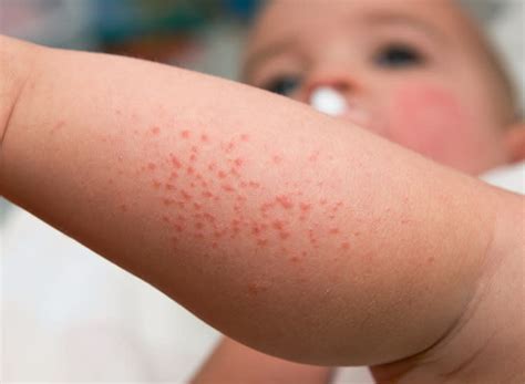 Meningitis Rash On Face / From Meningitis To Eczema And Measles The Ultimate Baby Rash Guide And ...