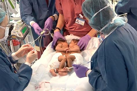 Inside the Successful Separation Surgery of Conjoined Twins | Columbia University Irving Medical ...