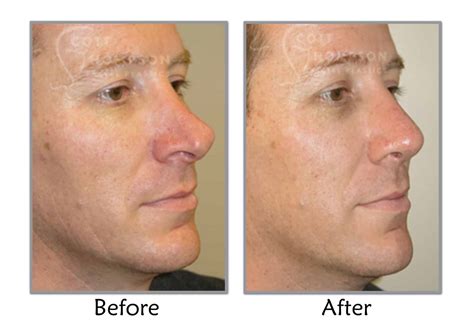 Deviated Septum Repair in Utah | Functional Nasal Surgery