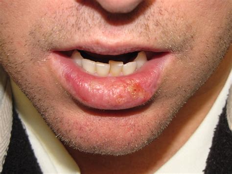 Squamous Cell Lip Cancer Pictures | Sitelip.org