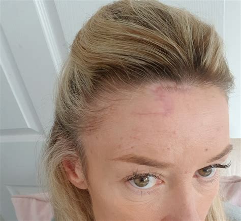 Woman left with 'Harry Potter' scar after skin cancer removed from forehead | Fox News